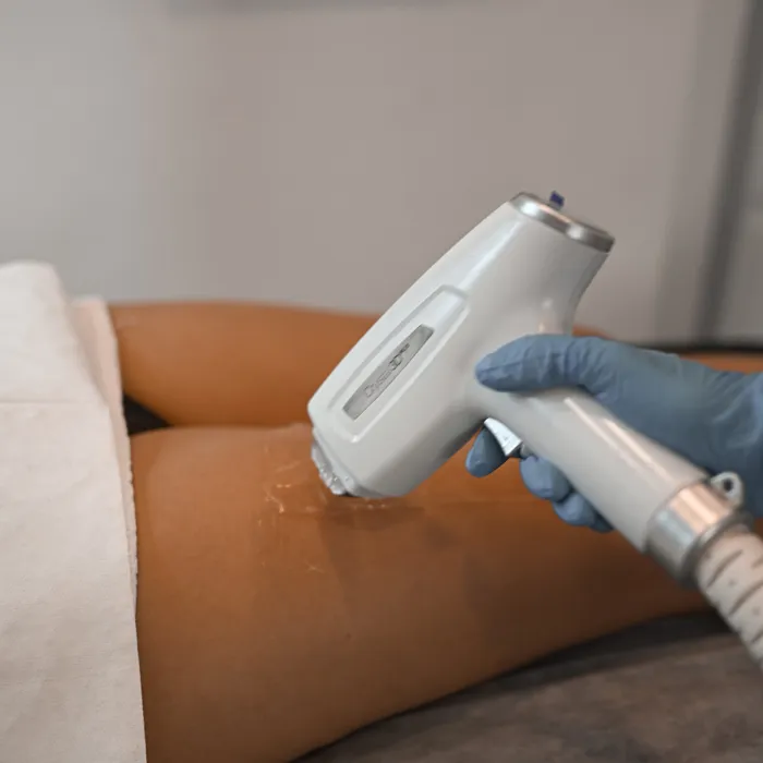 Aplicación de aparatología en una sesión de vacumterapia corporal
